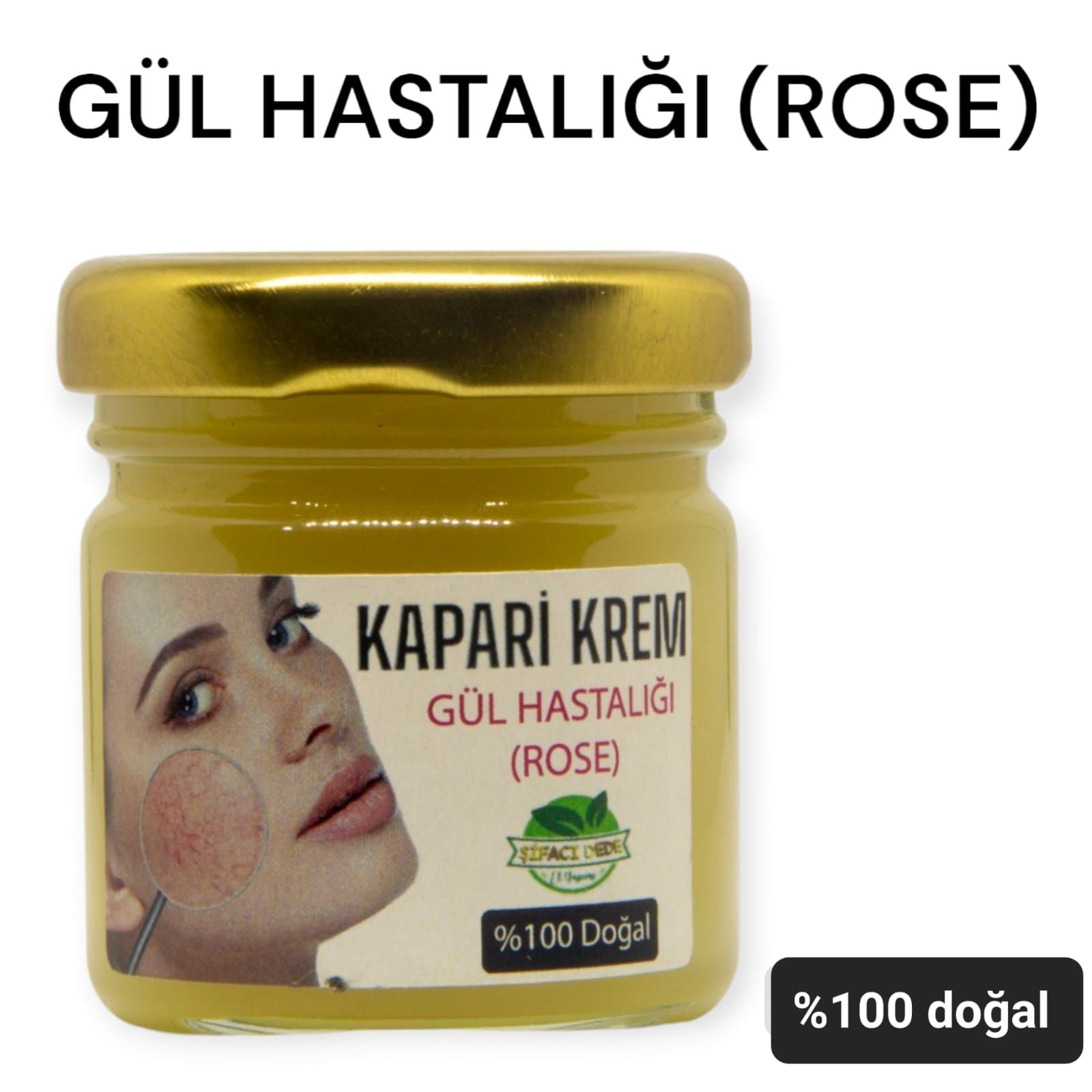 KAPARİ KREM- GÜL HASTALIĞI(ROSE)